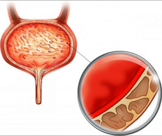 Inflammation of cystic